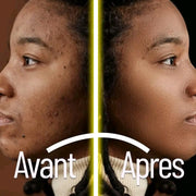 Huile Ultra-Efficace pour le Soins de la Peau (Cassia Alata)